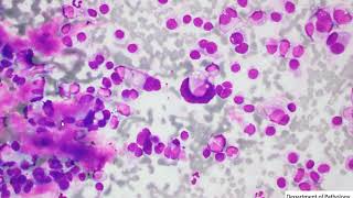 Thyroid FNA cytology  Medullary thyroid carcinoma [upl. by Atteram]