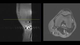 3 findings in 46 year old knee [upl. by O'Mahony]