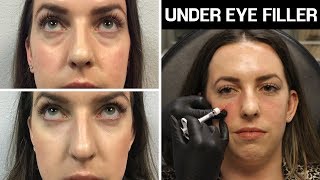 All About Under Eye Filler 💉 Restylane amp Restylane Lyft Before amp After Photos Does It Work Cost [upl. by Evilo]