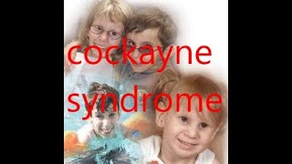 cockayne syndrome [upl. by Drofnas]