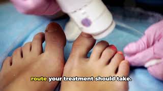 Laser Foot Nail Treatment The Ultimate Fungus Fighter [upl. by Aliuqet368]