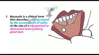 Mucocele HISTOPATHOLOGYMucous Extravasation cyst vs Mucous retention cyst  EtiopathClinical [upl. by Yregerg291]