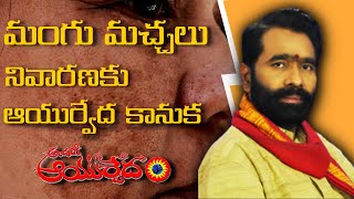 Mangu Machalu Remedy  మంగు మచ్చలు క్షణాలలో తగ్గాలంటే  Mangu Spots Authentic Ayurvedic Remedies [upl. by Thornton]