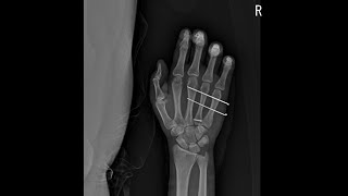 4th metacarpal base fracture [upl. by Stiruc]