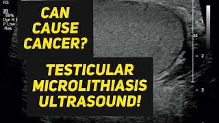 Testicular microlithiasis ultrasound [upl. by Airbas]