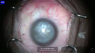 Phaco  Hard Mature Cataract [upl. by Ardisj]