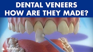 Veneers  How are they made Preparation and placement of cosmetic dentistry veneers © [upl. by Jarek]