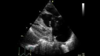 PULMONARY EMBOLISM  EMBOLIE PULMONAIRE  ECHOCARDIOGRAPHY cardiac ultrasound [upl. by Anabal462]