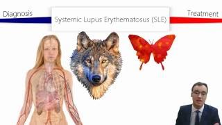 Systemic Lupus Erythematosus SLE [upl. by Caiaphas]