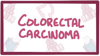 Colorectal carcinoma  causes symptoms diagnosis treatment pathology [upl. by Meece]