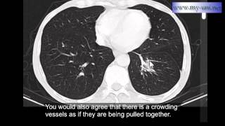 Rounded atelectasis  CT scan of Chest [upl. by Htebilil]