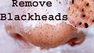 How to Remove Blackheads from Nose in 3 Days 100 Working Naturally at Home [upl. by Ysdnyl941]