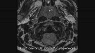 The plastic monster ependymoma how do you deal with this brain tumor in a six year old child [upl. by Rasla817]