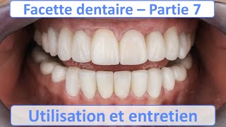 Facette dentaire  Utilisation et Entretien  Guide complet  Partie 7 [upl. by Lasser808]