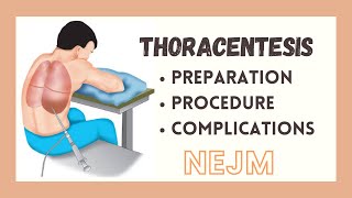 Thoracentesis  Preparationl amp Procedure Steps tutorial NEJM  MS  BOARDS [upl. by Marji]