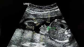 Gastroschisis ultrasound case [upl. by Franek]