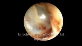 Sudden Hearing Loss Treatment SSHL  Intratympanic Steroid Injection [upl. by Azila977]