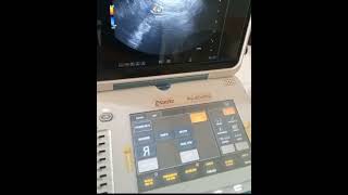 Esaote Mylab Gamma TVS pregnancy ultrasound medicalequipment [upl. by Akimaj]