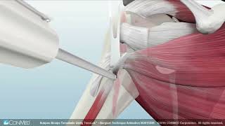 Biceps Tenodesis Using TenoLok® [upl. by Ermin846]