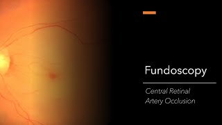 Central Retinal Artery Occlusion CRAO Fundoscopy [upl. by Ahsoyek]