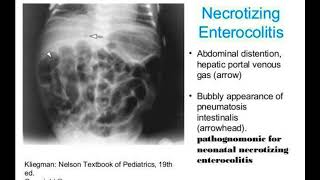 Necrotizing enterocolitis2 [upl. by Ramona]