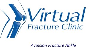 Avulsion fracture to ankle [upl. by Firahs]