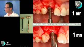 Implants Dentaires  Lexpansion osseuse par le Dr Thierry BRINCAT  GI TV [upl. by Battiste701]