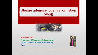 Uterine arteriovenous malformation AVM [upl. by Fiora]