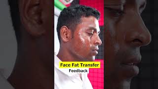 Face Fat transfer result  Patient Feedback shorts [upl. by Yelrac]