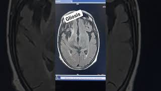 Mri Brain Gliosis old CVA case [upl. by Winebaum]