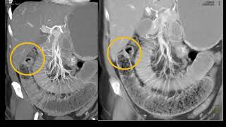 MDCT of the Small Bowel and Mesentery Inflammatory Disease Part 1 [upl. by Elianora22]