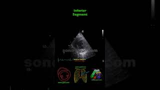 Echocardiography  Inferolateral And Inferior Hypokinesia [upl. by Garold]