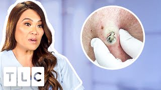 Top 5 Pimple Popping Moments From A 55YearOld Blackhead To Oozing Fistulas [upl. by Acinoda549]