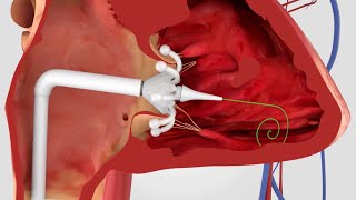 Minimally Invasive Procedures for Structural Heart Disease [upl. by Adair717]