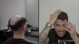 Antes y después prótesis capilar indetectable David V  Hair Inspira [upl. by Repohtsirhc28]