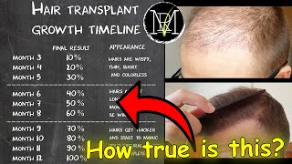 Hair Transplant growth timeline  Month 19  Norwood 5 [upl. by Otila]