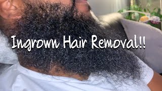 The Most Satisfying Ingrown Hair Removal From Beard [upl. by Itsa]