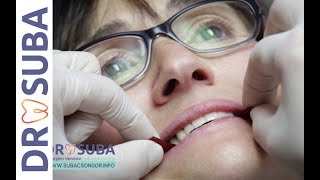 Prothèse fixe sur implant Refaire toutes ses dents Le travail du dentiste [upl. by Adnohsar610]