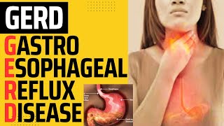 GASTROESOPHAGEAL REFLUX DISEASE  GERD  HEARTBURN  ACID REFLUX  ESOPHAGEAL REFLUX DISEASE [upl. by Yriek]