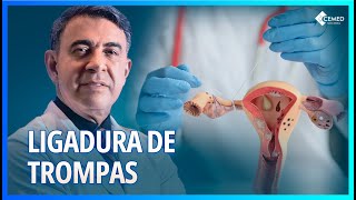 LAQUEADURA  VOCÊ SABE COMO É FEITA A LIGADURA DE TROMPAS [upl. by Fionna]