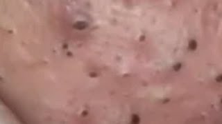 Huge Acne Pimples Blackheads Popping Up Satisfying with Oddly Calm Music Part One [upl. by Samuela]