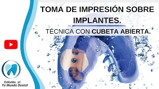 📋GUÍA PASO A PASO Impresión de implantes con cubeta abierta [upl. by Adniled7]