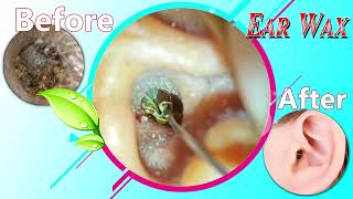 Ear Wax Removal Myths Debunked What You Need to Know 088 [upl. by Ahseik]