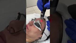 PicoSure Laser Treatment for dark spots shorts satisfying antiaging lasertreatment picosure [upl. by Halsy]