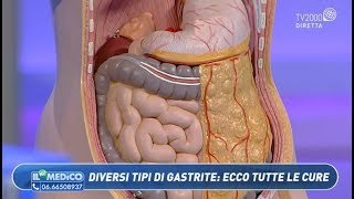 Il mio medico  Diversi tipi di gastrite ecco tutte le cure [upl. by Aronael491]