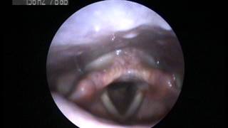 Videostroboscopy of a singer How does your voice work [upl. by Ibed]