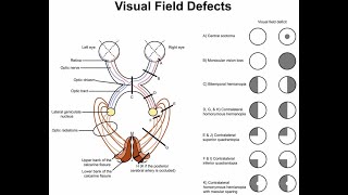 Lesions in the lower optic radiations and superior quadrantanopia [upl. by Ynahteb]