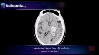 Stroke Hypertensive haemorrhage  radiology video tutorial MRI CT [upl. by Esialb]