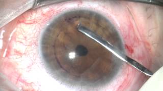 DMEK surgery sutureless corneal transplant [upl. by Adyeren]