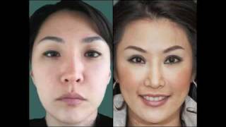 Asian Eyelid Surgery by Dr Charles S Lee [upl. by Jarv]